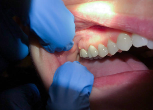 Best Emergency Treatment for Oral Infections in Centre, AL